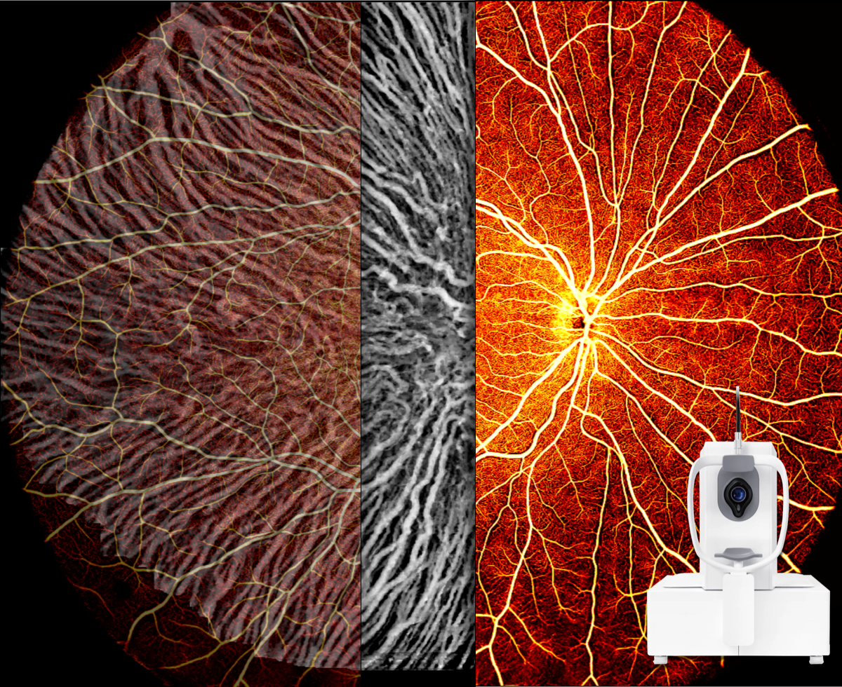 DREAM OCT ultra-wide-field retinal imaging